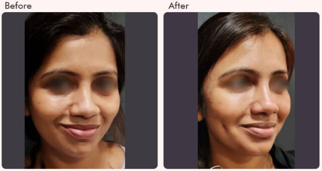 before-after-result-dimple-creation-01