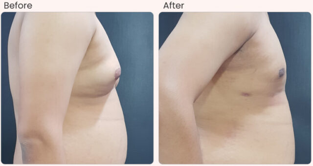 before-after-result-Gynecomastia-02