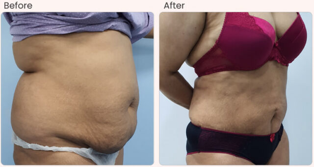 before-after-result-liposuction-02 (1)