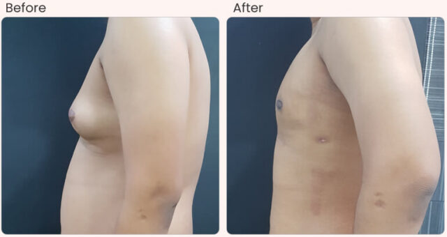 before-after-result-Gynecomastia-03