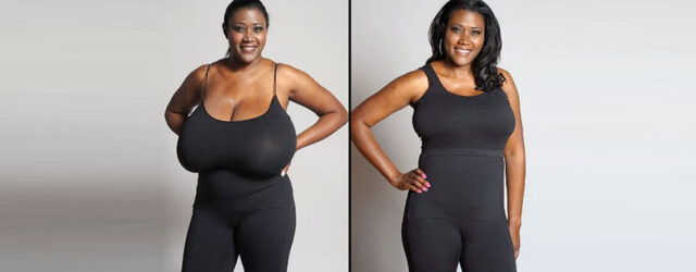 Breast-Reduction-Surgery-RG-Flap-Technique-Surgery-Dr-Rajat-Gupta-Plastic-surgery-specialist-Delhi-RG-Aesthetics