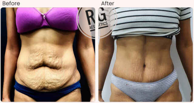 before-after-result-tummy-tuck-02
