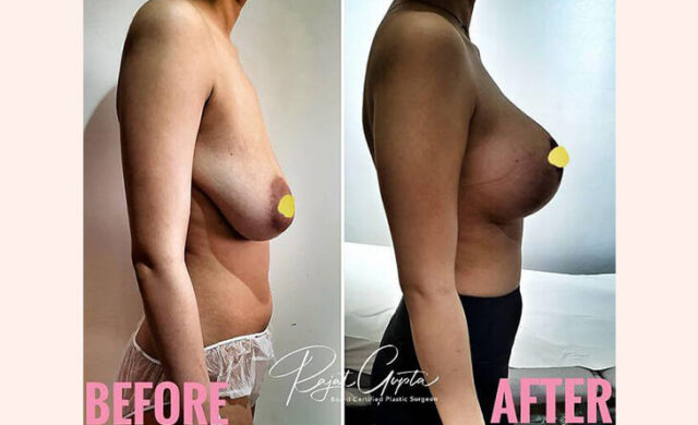 Breast-Lift-Before-After-Results-Dr-Rajat-Gupta-Breast-lift-surgery-cost-in-delhi-RG-Aesthetics-01