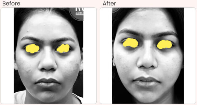 before-after-treatment-buccal-fat-removal-102
