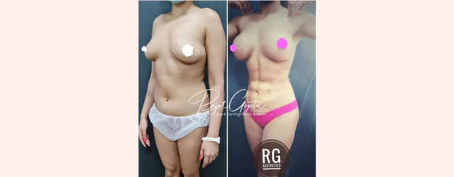 Liposuction-Surgery-in-Delhi-Top-Rated-Liposuction-Surgeons-With-Patient-Reviews