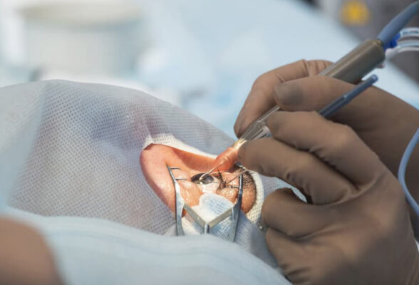 Can-I-Live-With-Cataracts-Without-Surgery-Dr-Anisha-Gupta-Eye-Doctor-in-Delhi