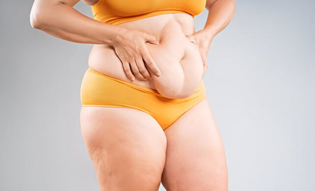 Tummy-Tuck-Dr-Rajat-Gupta-Plastic-Surgeon-in-Delhi-02