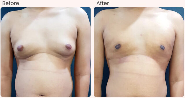 before-after-result-Gynecomastia-01