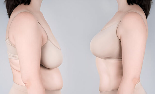 Upper-Pole-Fullness-Breast-Reduction-Dr-Rajat-Gupta-RG-Aesthetics-01