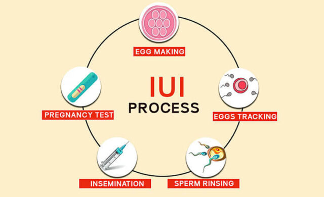 Steps-of-IUI-Procedure-Dr-Rhythm-Gupta-Excel-IVF-640x390