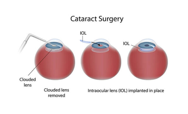 Cataract-Eye-Surgery-Dr-Anisha-Gupta-03
