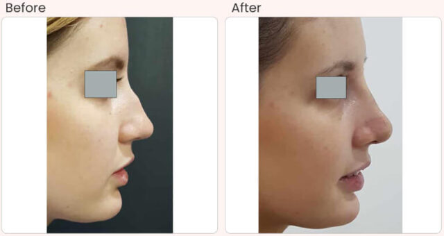 before-after-treatment-rhinoplasty-Dr-rajat-gupta-024 (1)